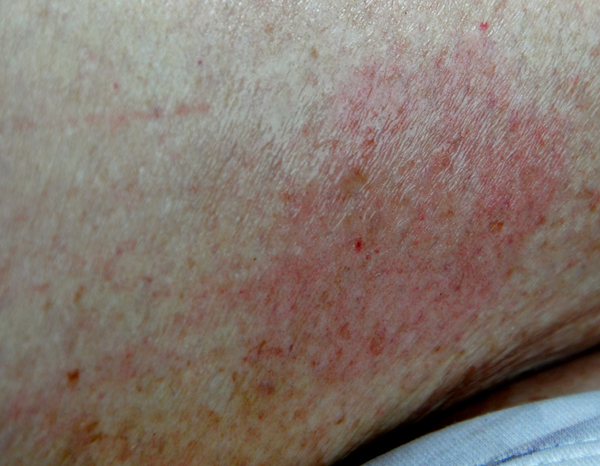 Karen Duquette's rash or bite on her leg