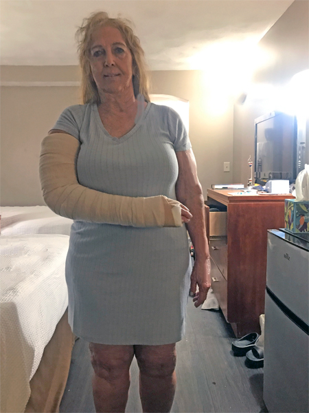 Karen Duquette's right arm in a temporay cast.