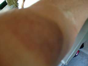 Karen's black and blue bruise